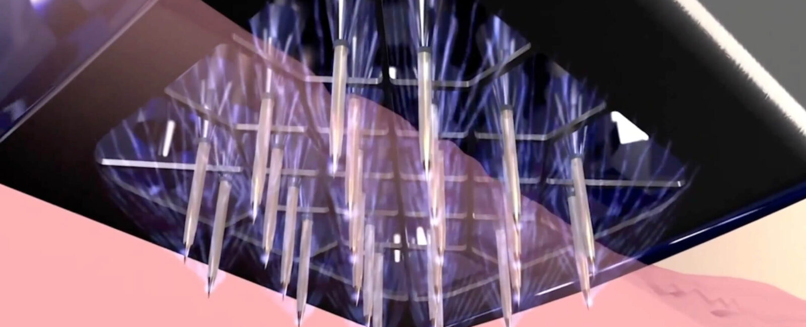 Dieses Bild zeigt die Unterseite des Applikators mit den Morpheus8 Mikronadeln, die durch ein feines Raster präzise in die Haut eingebracht werden. Dank der integrierten Vakuumtechnologie wird das zu behandelnde Hautareal sanft angesaugt, so können die Nadeln mit gleichmäßigem Druck und exakter Tiefe in die Haut eindringen. Gleichzeitig wird Radiofrequenzenergie in das Gewebe geleitet, um die Regeneration der Haut in der Tiefe zu fördern.

Die Vakuumunterstützung sorgt nicht nur für mehr Komfort, sondern auch für gleichmäßige Behandlungsergebnisse, selbst in sensiblen Bereichen wie Gesicht, Hals oder Dekolleté.