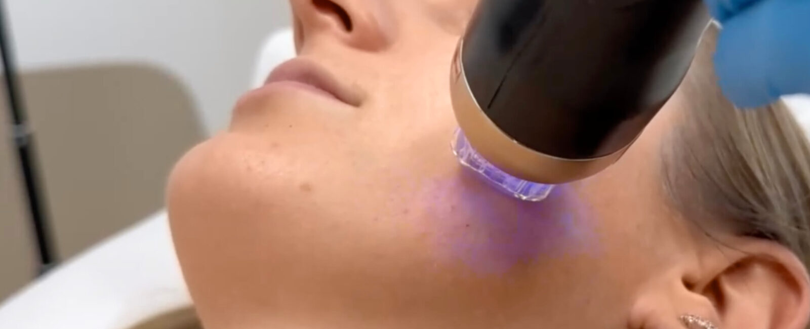 Auf dem Bild sieht man eine Frau die gerade eine Behandlung bei Dermacare bekommt. Es ist eine ähnliche wie die Morpheus8 Behandlung, die sogenannte Radiofrequenz Microneedling Behandlung.