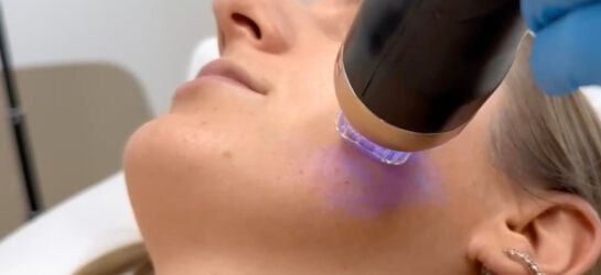 Auf dem Bild sieht man eine Frau die gerade eine Behandlung bei Dermacare bekommt. Es ist eine ähnliche wie die Morpheus8 Behandlung, die sogenannte Radiofrequenz Microneedling Behandlung.