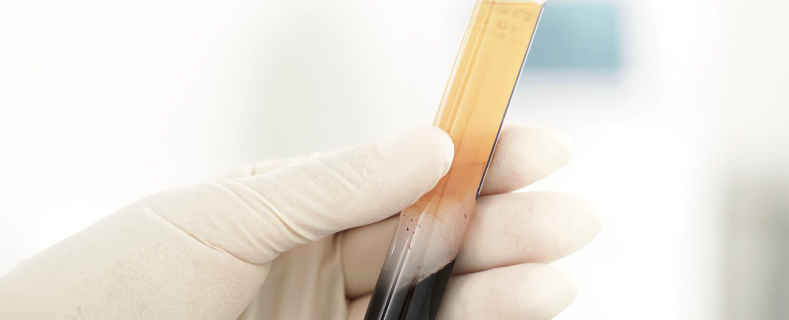 Das Bild zeigt eine behandschuhte Hand, die ein aufbereitetes Röhrchen mit plättchenreichem Plasma (PRP) hält. In der oberen, goldgelben Phase befindet sich das wertvolle Plasma, das im Rahmen der Eigenbluttherapie zur Hautverjüngung eingesetzt wird. Dieses Bild veranschaulicht den natürlichen Ursprung und die medizinisch präzise Vorbereitung der PRP-Behandlung – eine innovative Methode, die bei der Faltenbehandlung bei Dermacare gezielt mit anderen Verfahren wie der Faltenbehandlung mit Hyaluronsäure kombiniert wird. Das Ziel: frische, strahlende Haut durch körpereigene Regeneration und gezielte Faltenglättung – ganz ohne künstlichen Look.
