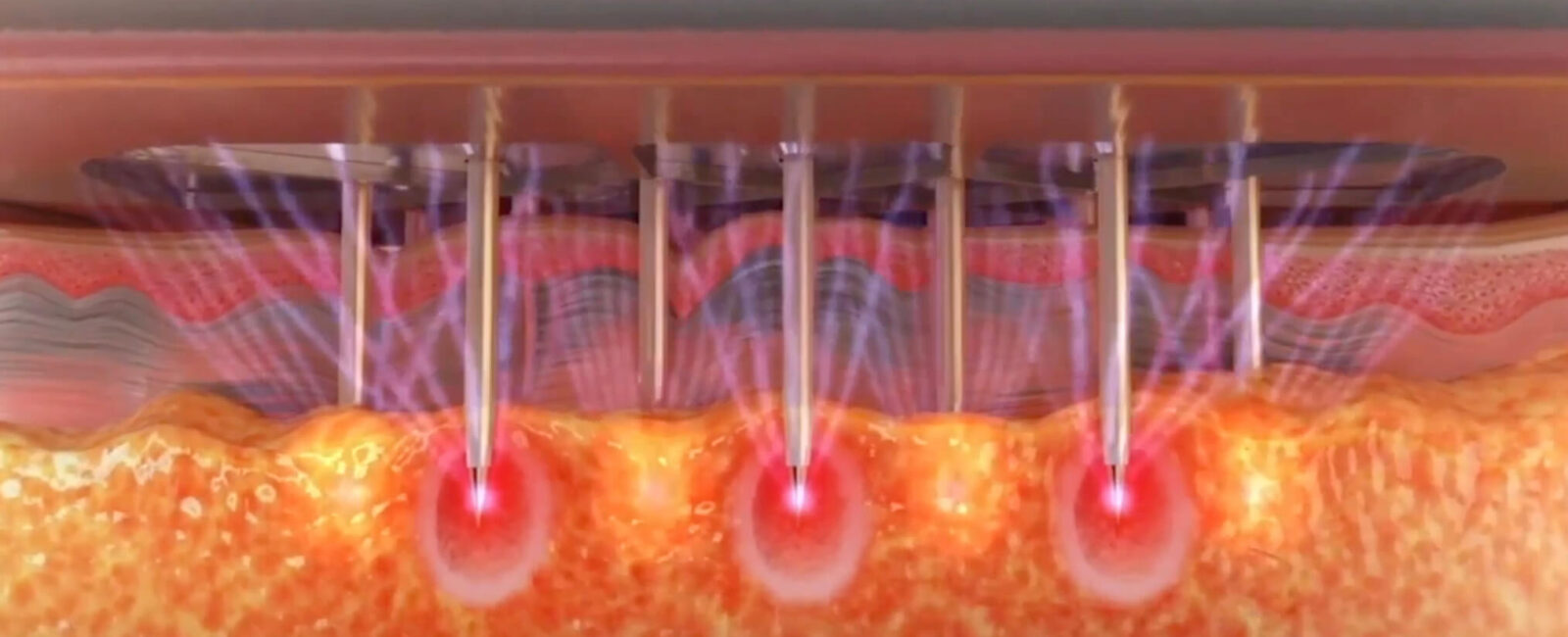 Das Bild zeigt die Wirkweise der Morpheus8 Behandlung in einer vergrößerten, schematischen Darstellung. Feine Mikronadeln dringen präzise in die Haut ein und geben dort kontrollierte Radiofrequenzenergie ab. Die rot leuchtenden Zonen symbolisieren die gezielte Erhitzung des Gewebes in der Tiefe genau dort, wo neue Kollagenfasern gebildet werden. Bei Dermacare Wien kommt dabei eine verbesserte Morpheus8 Technologie mit integrierter Vakuumtechnik zum Einsatz. Diese sorgt dafür, dass die Nadeln besonders gleichmäßig und sanft eindringen – was nicht nur die Wirksamkeit, sondern auch den Komfort deutlich erhöht.