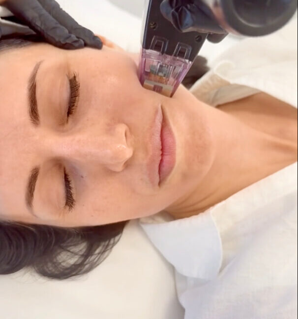 Hier sieht man wie eine Patientin im Gesicht eine RF Microneedling Behandlung bekommt. Feine Nadeln dringend schonend in ihre Haut ein. Sie wirkt sehr entspannt
