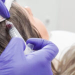 Hier auf dem Bild sieht man schön wie bei Dermacare Wien die Stammzellentherapie für Anti Aging angewendet wird. Stammzellen werden der Patientin direkt in die Kopfhaut injiziert.