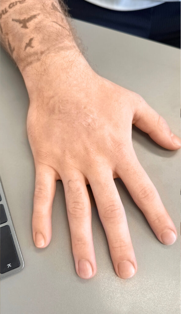 Hier ist das Nachher Bild einer Tattooentfernung. Man sieht dass zu 100% ein Tattoo entfernen werden konnte. Die Haut der Hand sieht makellos aus.