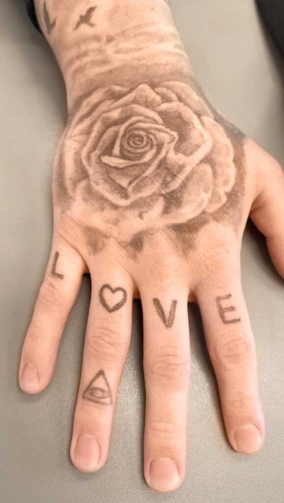 Hier sieht man ein Vorher Bild von einer Tattooentfernung bei Dermacare. Es ist noch zu 100% ein Tattoo auf der Hand sichtbar.