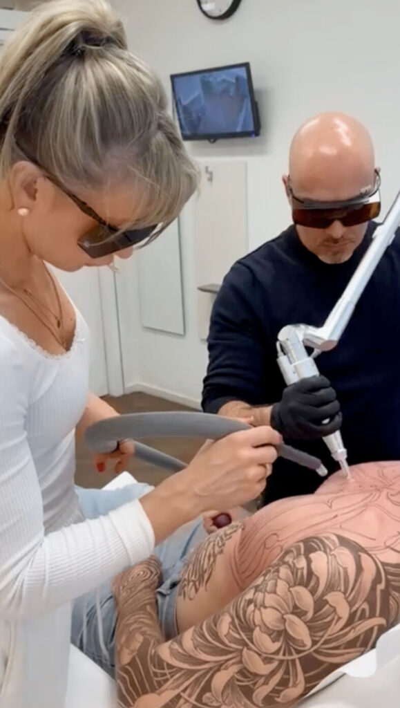 Auf dem Bild sieht man eine Behandlung bei Dermacare Wien. Der Patient wollte auf der Brust ein Tattoo weglasern lassen.