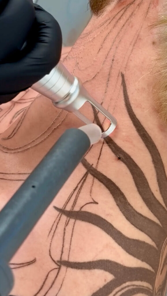 Hier sieht man nochmal von nahem wie man eine schwarzes Tattoo weglasern kann.