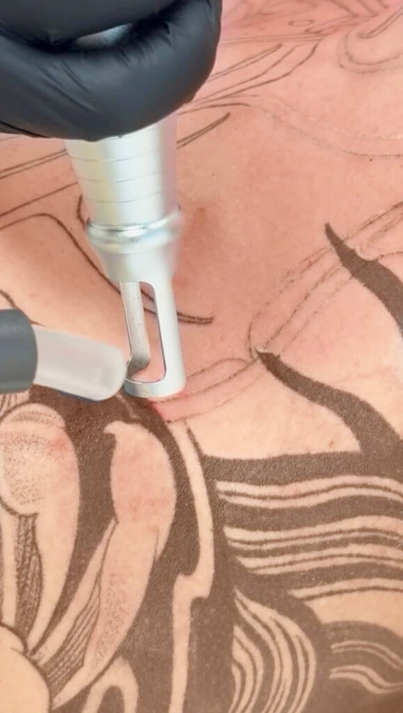 Hier sieht man die Laserbehandlung zur Tattooentfernung vom Nahen. Eine weitere Methode zur Tattooentfernung.