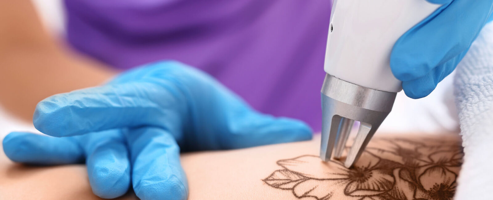 Auf dem Bild sieht man welche Methoden zur Tattooentfernung wirksam sein könnten: in unserem Fall ist es die Laserbehandlung, wie man sie schön aufdem Bild sieht. Das Tattoo wird schonend weggelasert.