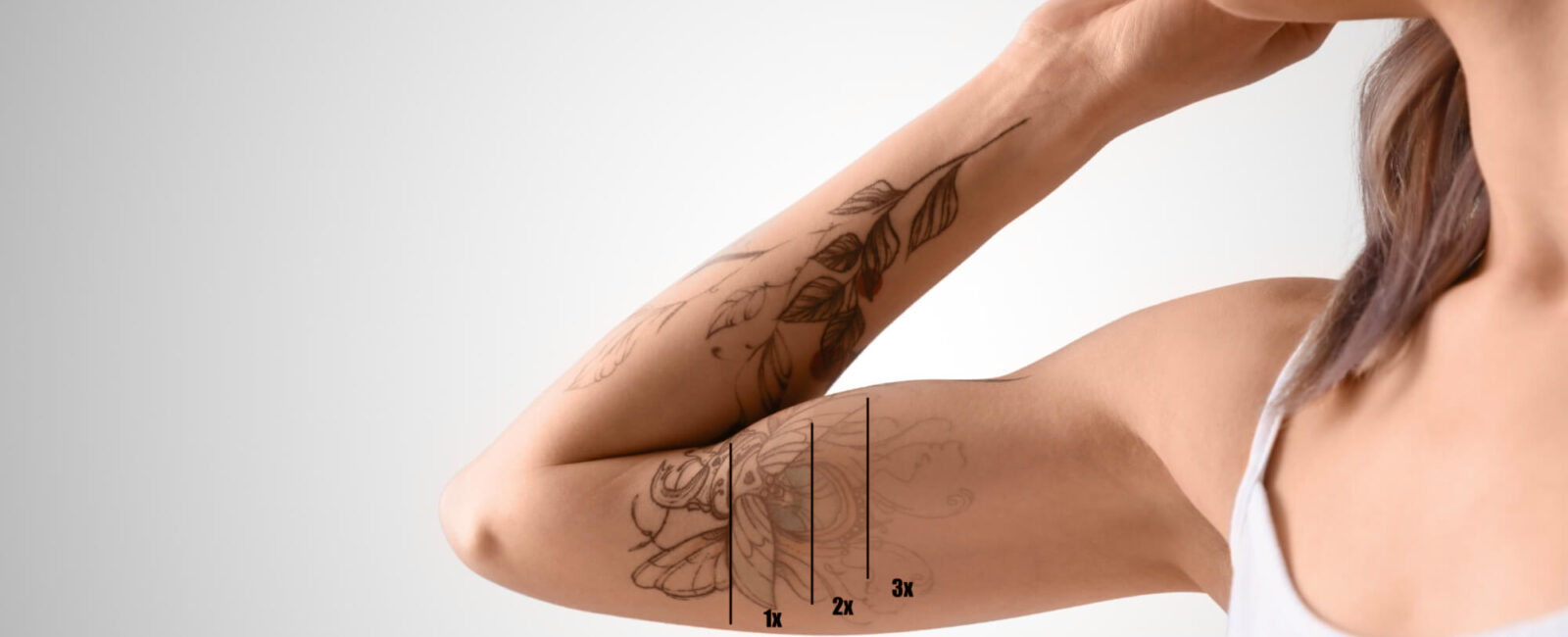 Auf dem Bild sieht man wie ein Tattoo auf dem Arm langsam verschwindet. Nach mehrer Sitzungen kann man beinahe jedes Tattoo weglasern lassen, vor allem wenn sie zu Dermacare Wien kommen.