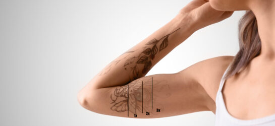 Wie lange dauert es, ein Tattoo weglasern zu lassen? Auf dem Bild sieht man wie ein Tattoo auf dem Arm langsam verschwindet. Nach mehrer Sitzungen kann man beinahe jedes Tattoo weglasern lassen, vor allem wenn sie zu Dermacare Wien kommen.