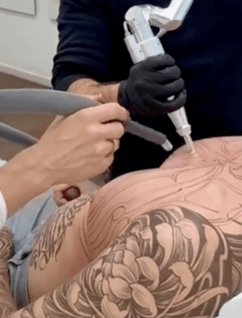 Auf dem Bild sieht man eine Behandlung bei Dermacare Wien. Der Patient wollte auf der Brust ein Tattoo weglasern lassen.