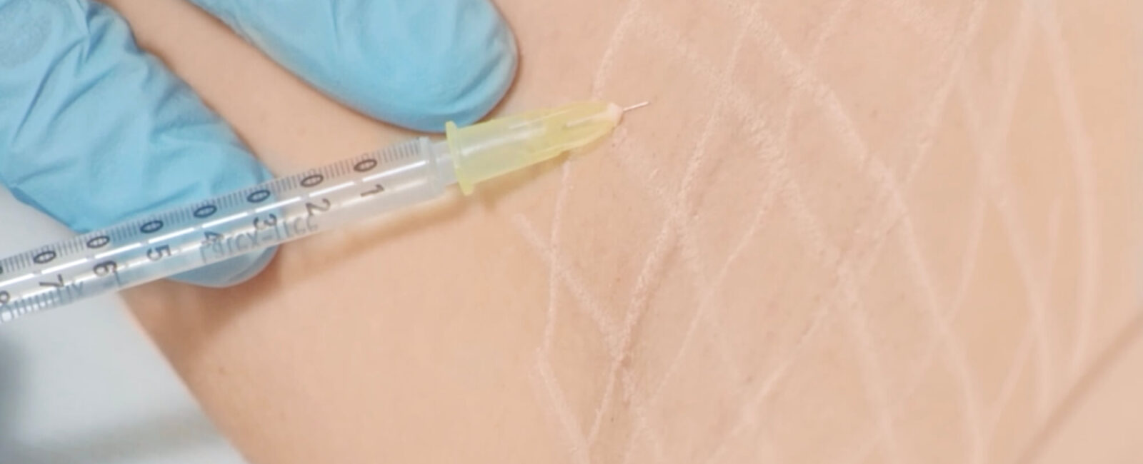 Präzise Botox-Injektion gegen starkes Schwitzen Zu sehen ist die Behandlung einer Achsel mit einer feinen Botox-Injektion. Die markierte Fläche zeigt, wie gezielt bei Dermacare Wien gearbeitet wird. Die minimalinvasive Methode blockiert die überaktive Schweißproduktion dort, wo sie entsteht – sanft, punktgenau und nahezu schmerzfrei. Wer sich fragt: Was hilft gegen Schwitzen? – für viele ist genau diese Behandlung die effektive Antwort.