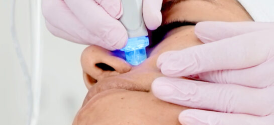 Nahaufnahme einer Hydrafacial-Behandlung in Wien: Das Handstück gleitet über die Kinnpartie der Kundin, während ein sanfter Wasserstrahl und Vakuumtechnik abgestorbene Hautzellen entfernt. Gleichzeitig werden pflegende Wirkstoffe eingeschleust, um die Haut zu regenerieren und den Teint zu verfeinern. Perfekt für alle, die eine gründliche Gesichtsreinigung mit sichtbarem Soforteffekt wünschen.