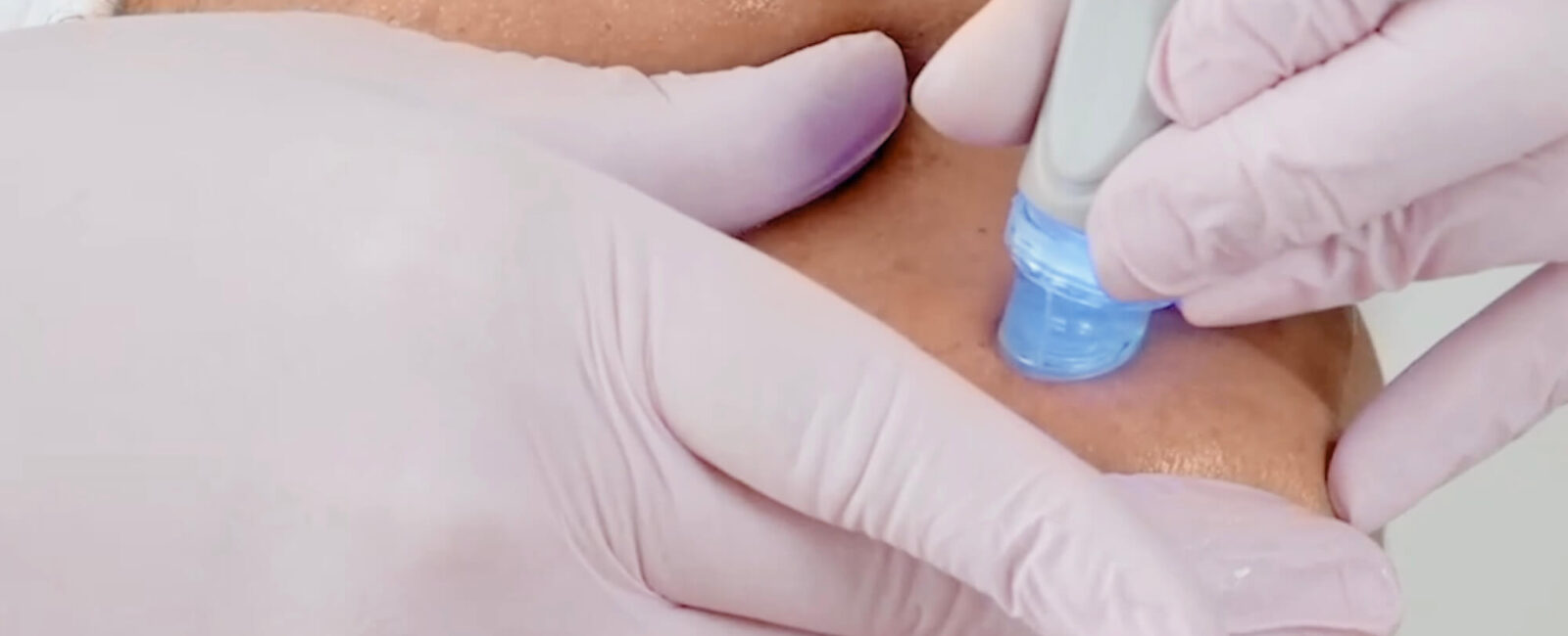 Hier sieht man Dermacares Tiefenreinigung im Sommer, eine Aquafacial Behandlung. 