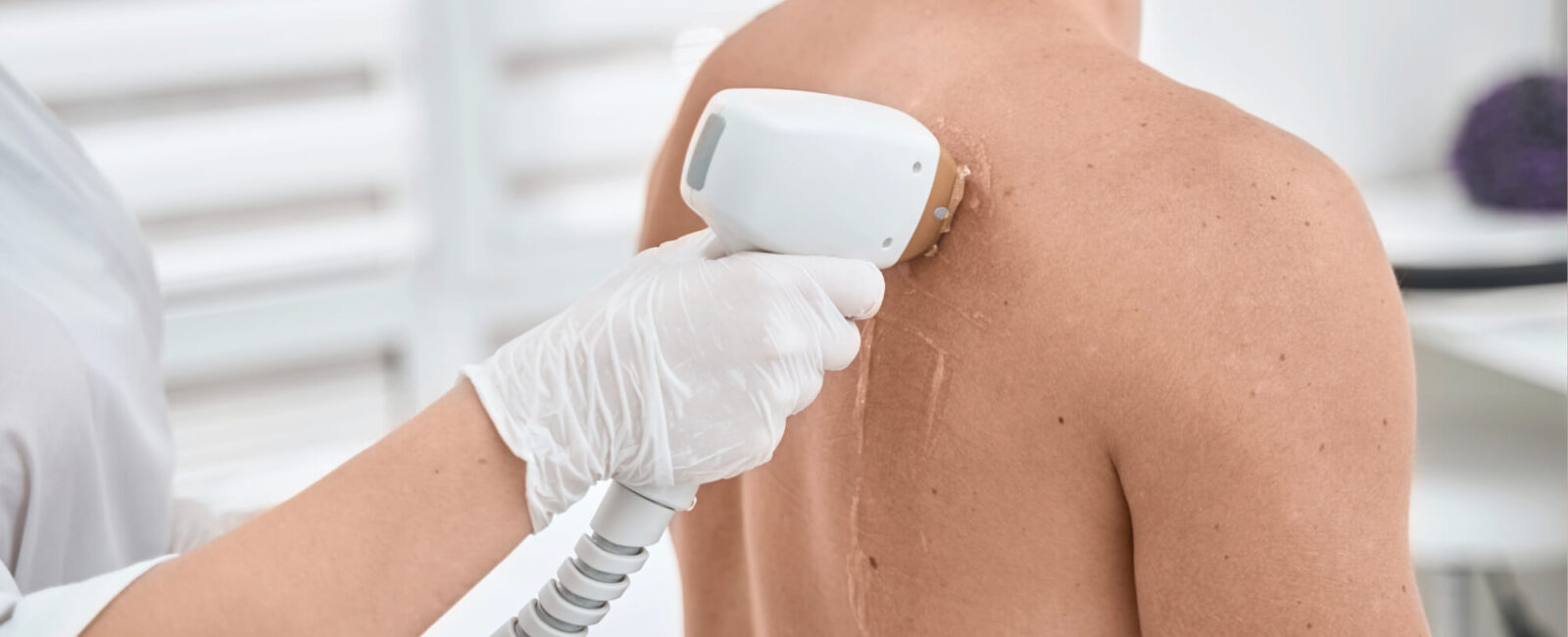Ein Fachpersonal führt eine Laser-Haarentfernung am Rücken eines Mannes durch. Die professionelle Behandlung sorgt für eine glatte, haarfreie Haut durch dauerhafte Haarentfernung – auch an schwer erreichbaren Körperstellen.