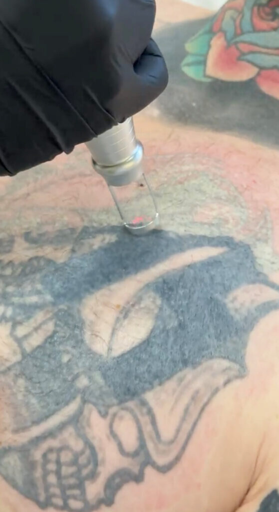 Tattoo überstechen oder entfernen – Laser vs. Cover-Up Hier ist die Tattooentfernung mittels Laser bei Dermacare Wien gut sichtbar. Könnte man dieses Tattoo überstehen? Wahrscheinlich schon, doch der Patient hat sich gegen das Cover-up und gleich für das weglasern entschieden.