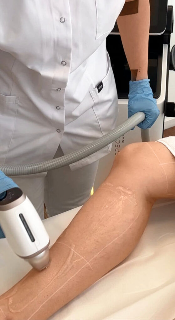 Hier ist ein weiter Einblick in Dermacares Laserhaarentfernung für glatte Beine. Das Lasergerät fährt sanft über die vorbereitete Stelle am Bein.