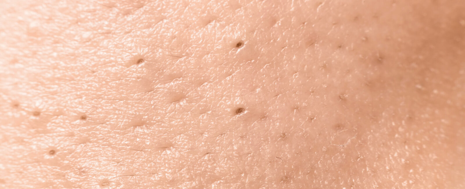 Auf diesem Bild sieht man den Grund weshalb man wirklich regelmäßig Mitesser entfernen sollte. Kleine schwarze Punkt auf der Haut deuten darauf hin dass man Mitesser hat.