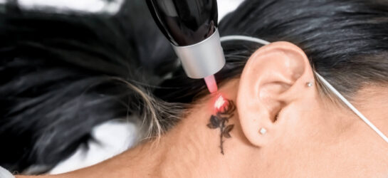 tattoo ueberstechen laser vs cover up halstattoo