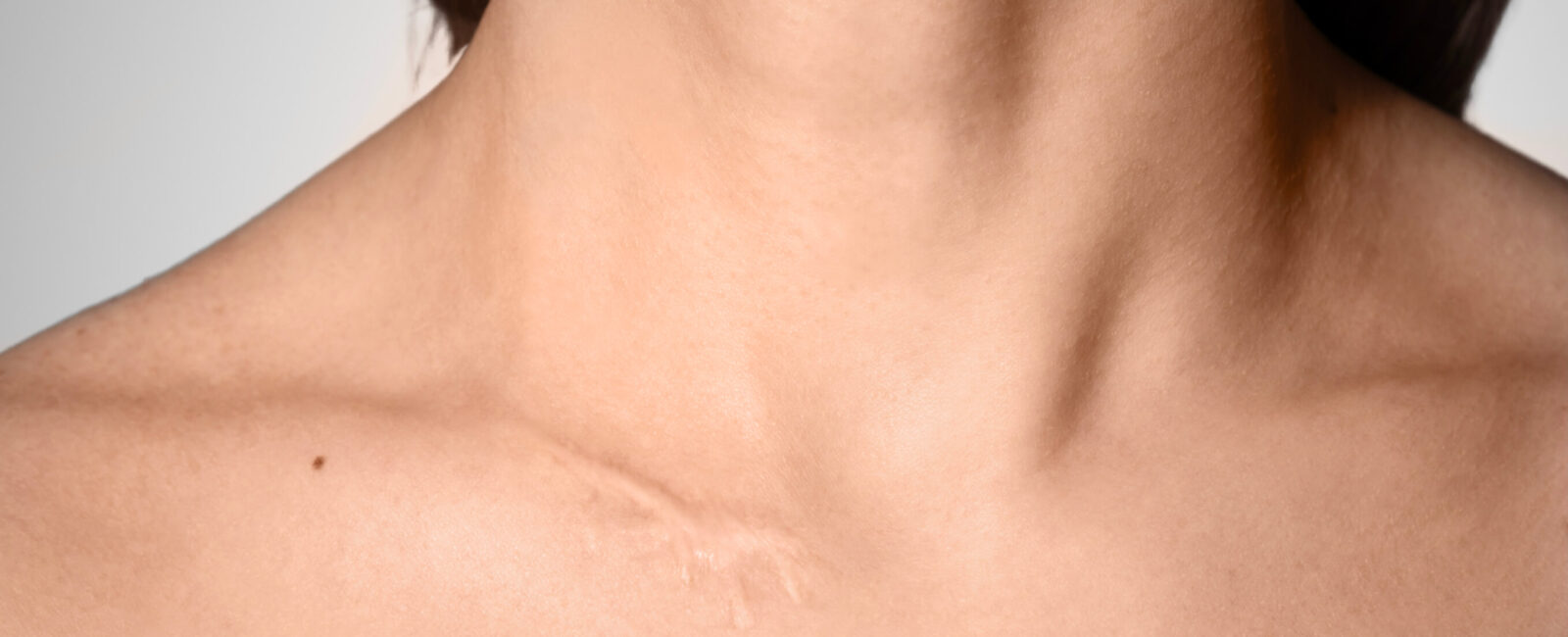 Tattoo über Narben – was Sie vorher wissen sollten Hier sieht man eine Narbe auf einem Schlüsselbein.