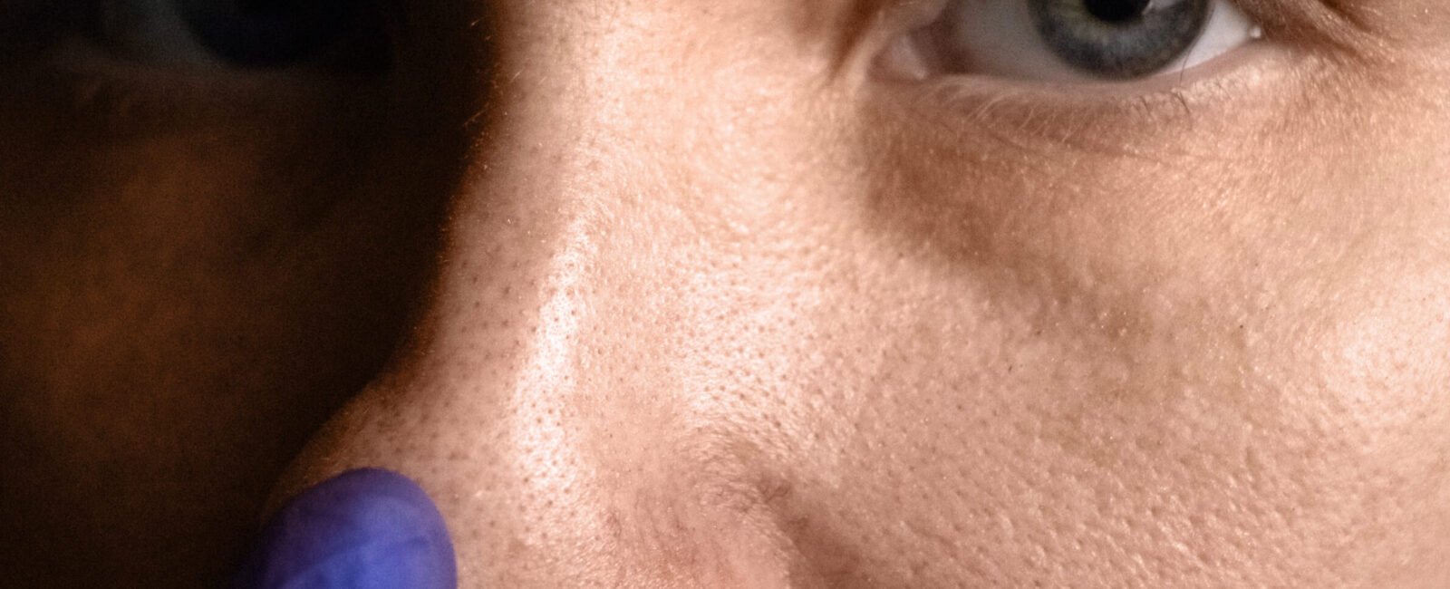 Hilfe gegen große Poren – Mit Radiofrequenz-Microneedling? Auf dem Bild ist eine Person mit große Poren zu sehen.