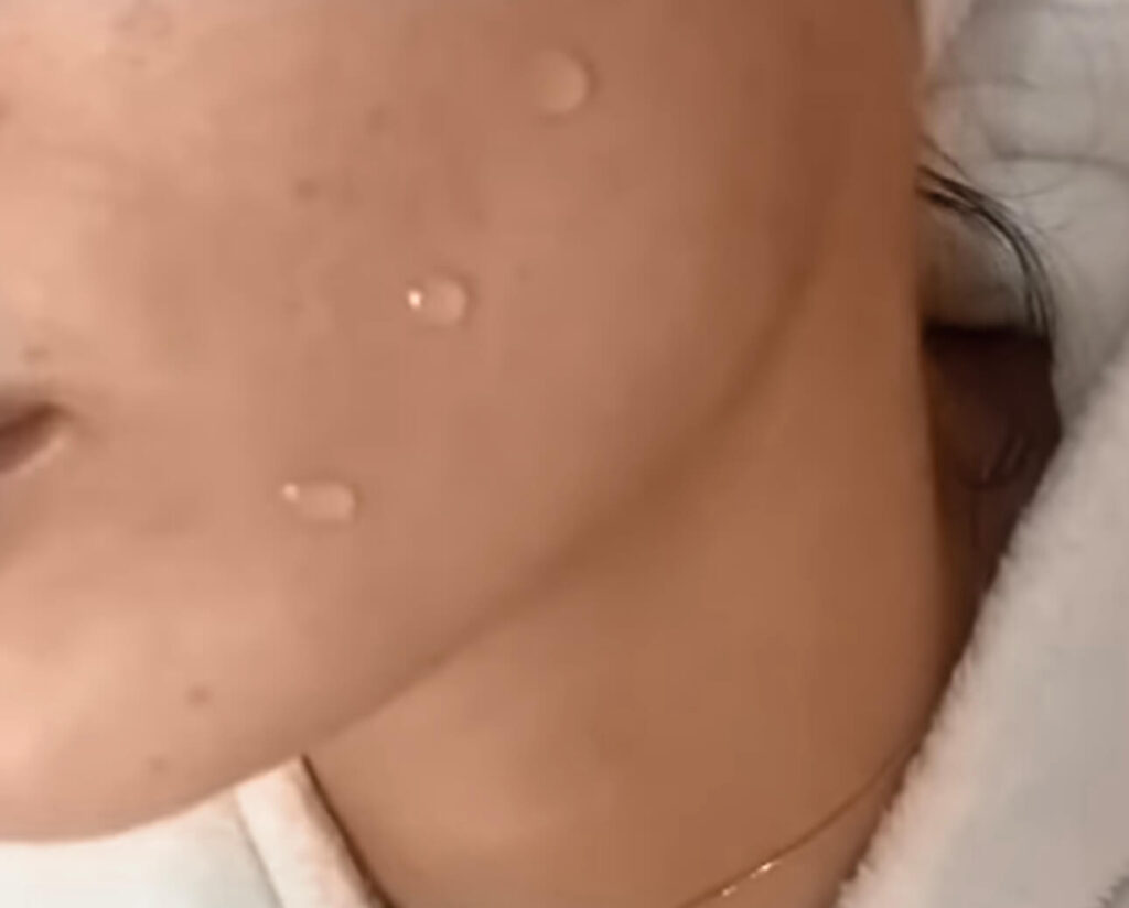 Das zweite Bild zeigt ein PQAge Peeling, ein sanftes, aber effektives professionelles Gesichtspelling von Dermacare Wien. Auf der Haut sind feine Tropfen einer Wirkstofflösung zu sehen, die tief in die Haut einwirken. Das PQAge Peeling kombiniert chemische und revitalisierende Komponenten, um die Hautstruktur zu verbessern, die Zellerneuerung anzuregen und einen strahlenden Teint zu erzeugen – ganz ohne Ausfallzeit.