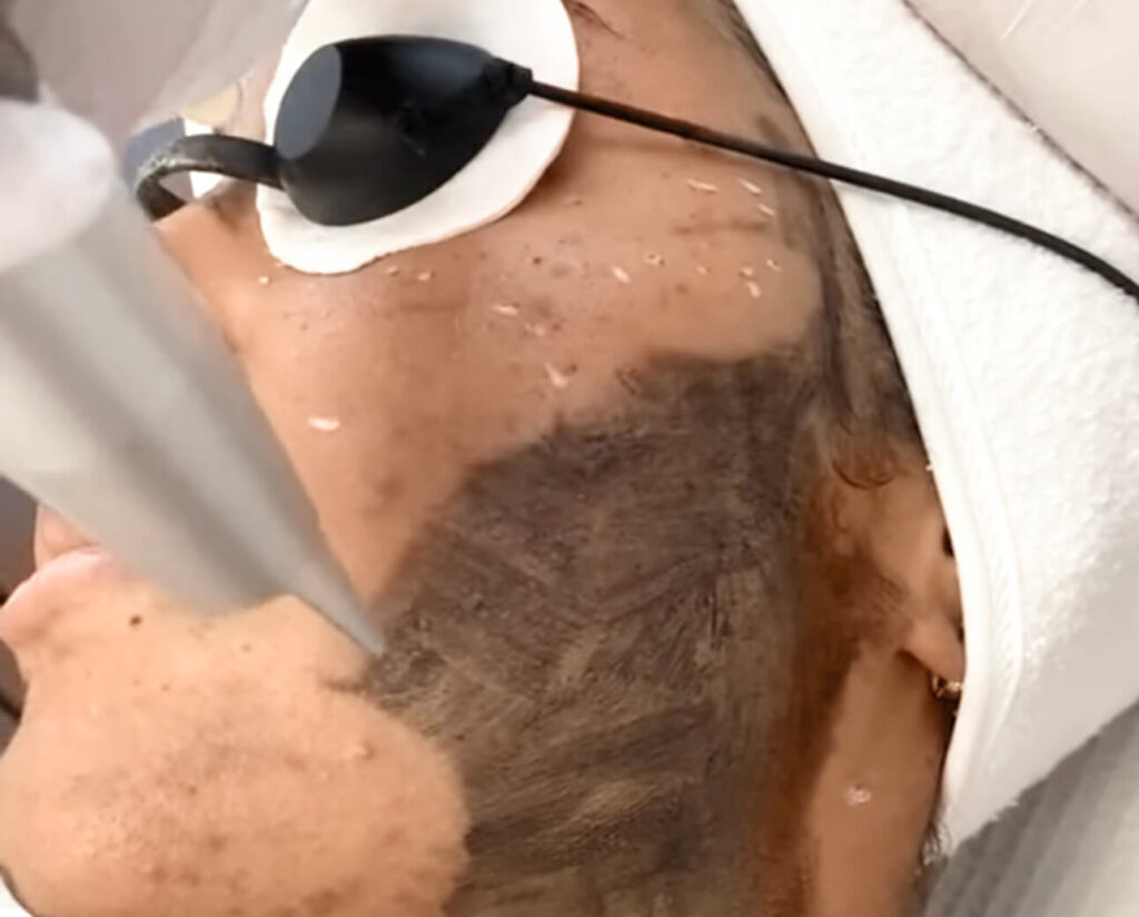 Das erste Bild zeigt ein professionelles Gesichtspelling mit einem Carbon-Laser-Peeling. Eine Person liegt entspannt mit Schutzbrille auf einer Liege, während eine Fachkraft ein Lasergerät über das Gesicht führt. Auf der Haut ist eine dunkle Carbonmaske zu sehen, die den Laserstrahl besser absorbieren soll. Diese Behandlung dient der Tiefenreinigung, Porenverfeinerung und Verbesserung des Hautbildes.