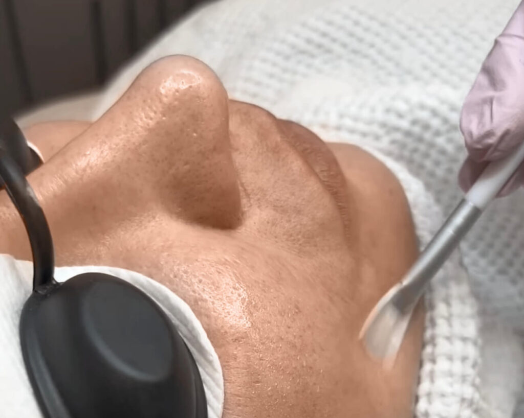 Das dritte Bild zeigt ein professionelles Gesichtspelling mit einem TCA-Peeling (Trichloressigsäure-Peeling), das ebenfalls bei Dermacare Wien durchgeführt wird. Eine Expertin trägt die Peelinglösung präzise mit einem Pinsel auf das Gesicht auf, während die Kundin eine Schutzbrille trägt. Diese Behandlung unterstützt die Hauterneuerung, mildert Pigmentflecken und verbessert die Hauttextur nachhaltig.