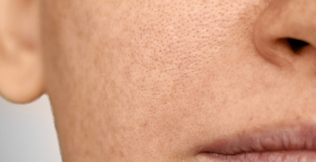 Vom Sommer gezeichnet - rechtzeitig Pigmentflecken loswerden Auf dem Bild sieht man erneut leicht pigmentierte Gesichtshaut, womöglich durch Sonneneinstrahlungen im Sommer. Wie man Pigmentflecken loswerden kann, erfährst du am besten von Dermacares Experten.
