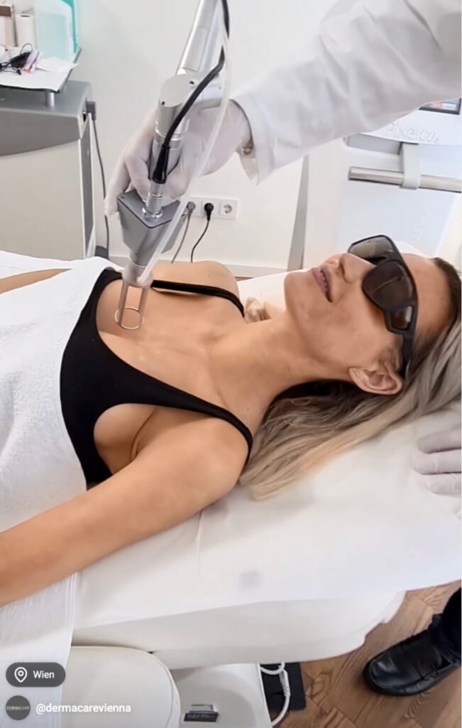 Hier seiht man eine Frau wie sie mit Dermacare Pigmentflecken loswerden wird. Sie bekommt gerade eine CO2 Laserbehandlung von Dermacare Wien