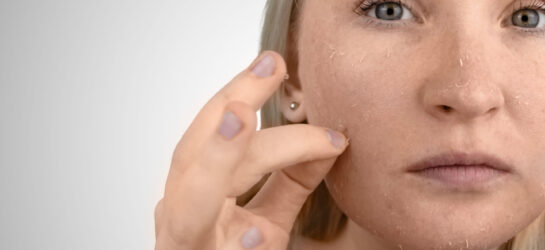 Auf dem Bild sieht man eine Frau die Probleme mit trockener haut im winter hat. Man sieht ihr Gesicht und wie sie mit den Fingern ihre Haut herunterzupft.