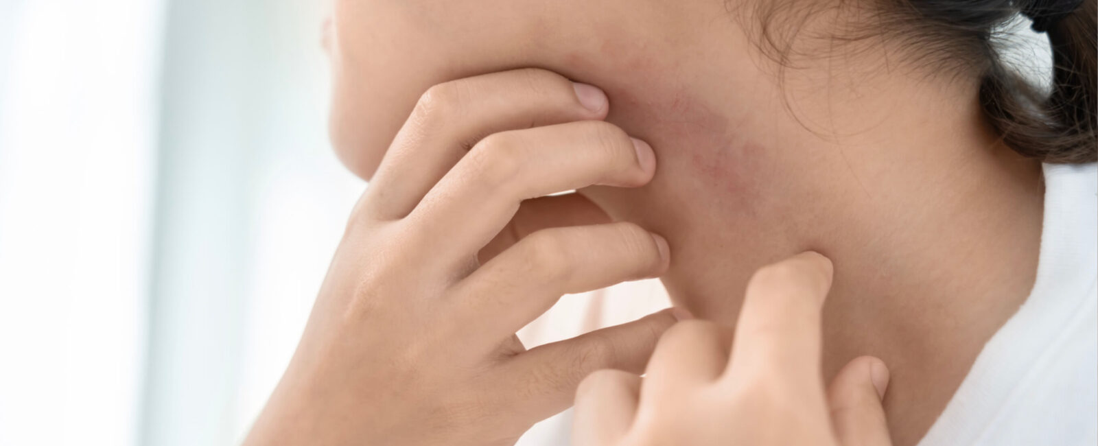 Unreine Haut durch Stress oder Hormone – so finden Sie die Ursache Hier sieht man wie eine Frau am Hals Pickel hat. Sie bekam wahrscheinlich unreine Haut durch Stress.