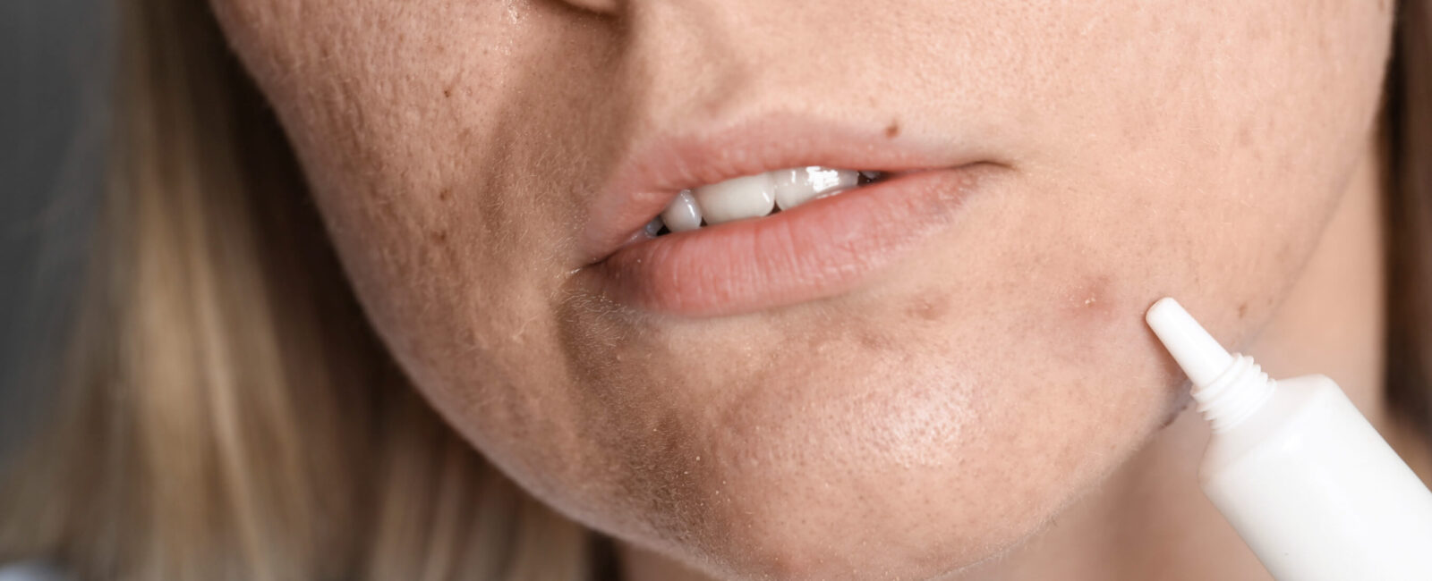 Dieses Bild zeigt unreine Haut durch Stress und Hormone. Man sieht eine Frau, die versucht mit eine Creme ihre Pickel abzudecken und zu beruhigen.