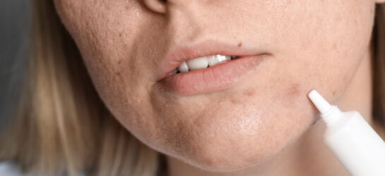 Dieses Bild zeigt unreine Haut durch Stress und Hormone. Man sieht eine Frau, die versucht mit eine Creme ihre Pickel abzudecken und zu beruhigen.