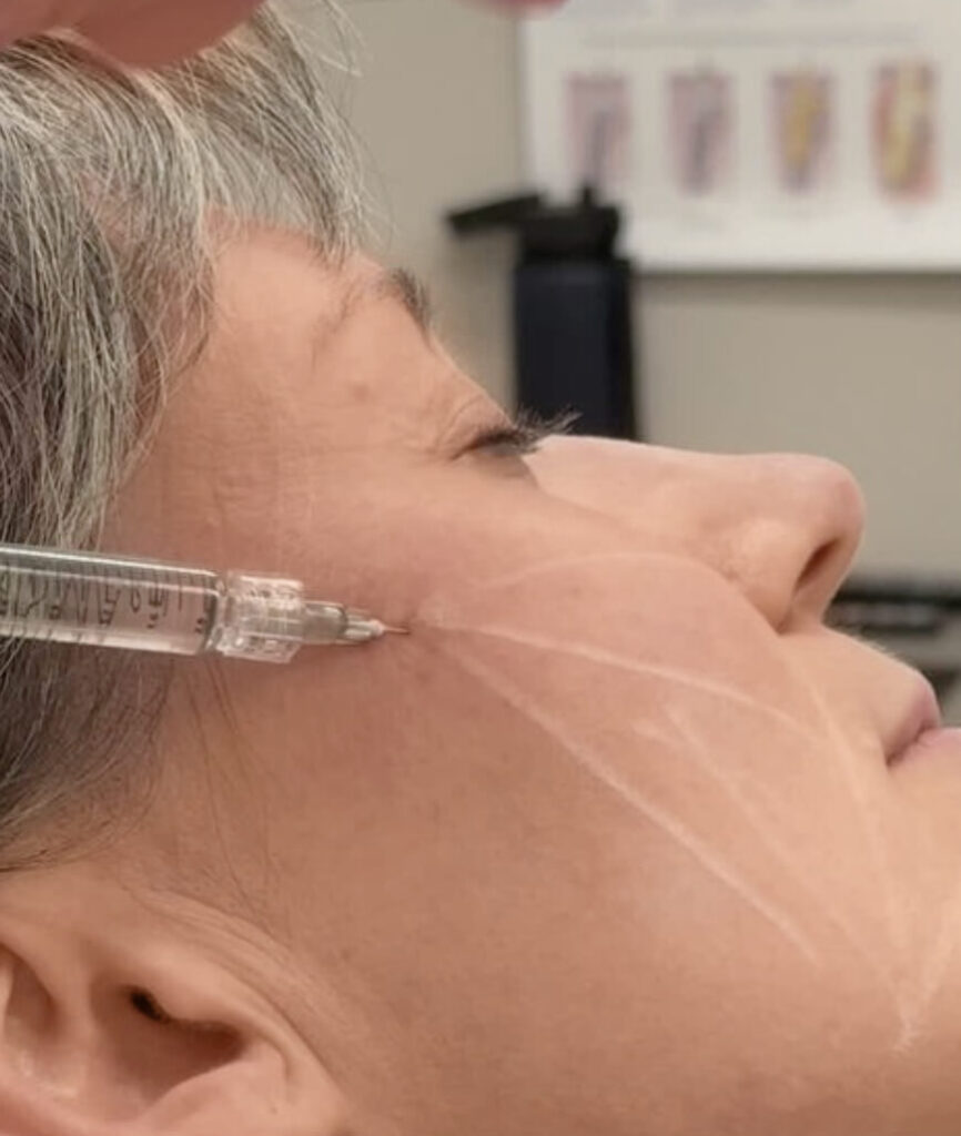 filler behandlung glow up Ballsaison wien Botox. wien