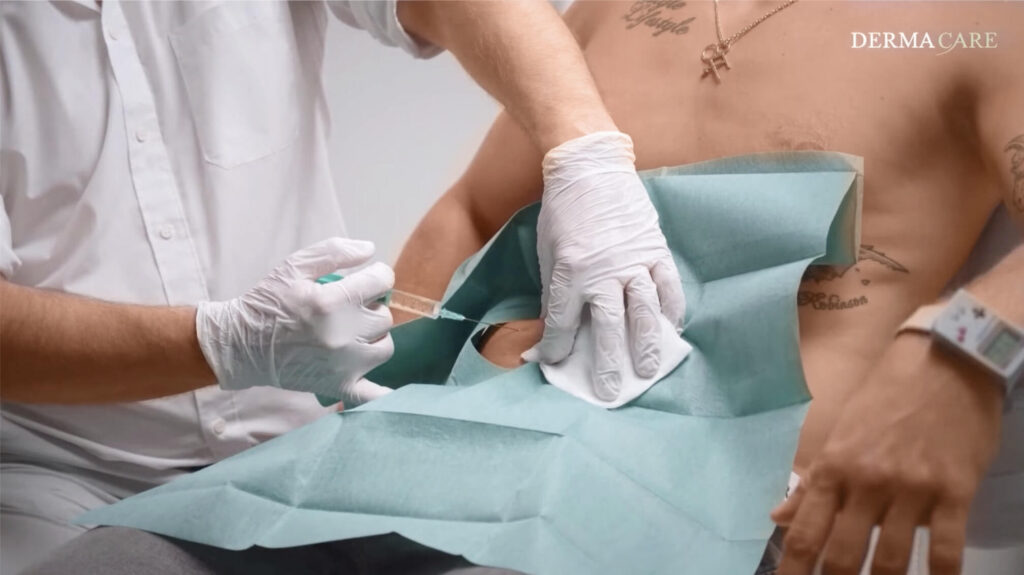 Auf dem Bild sieht man wie mittels Fettwegspritze gegen kleine Fettpölsterchen vorgegangen wird, so wir das Abnehmen nach Weihnachten leicht gemacht.